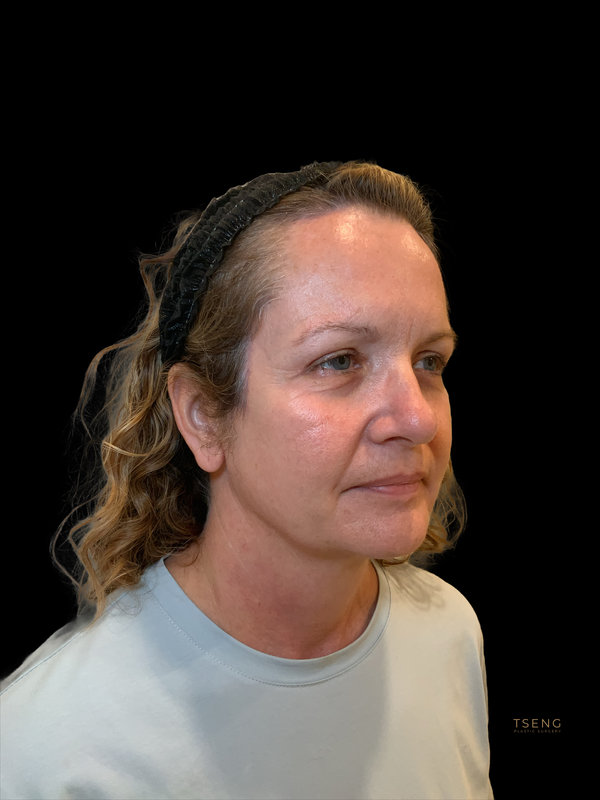 Brow lift Before & After Image