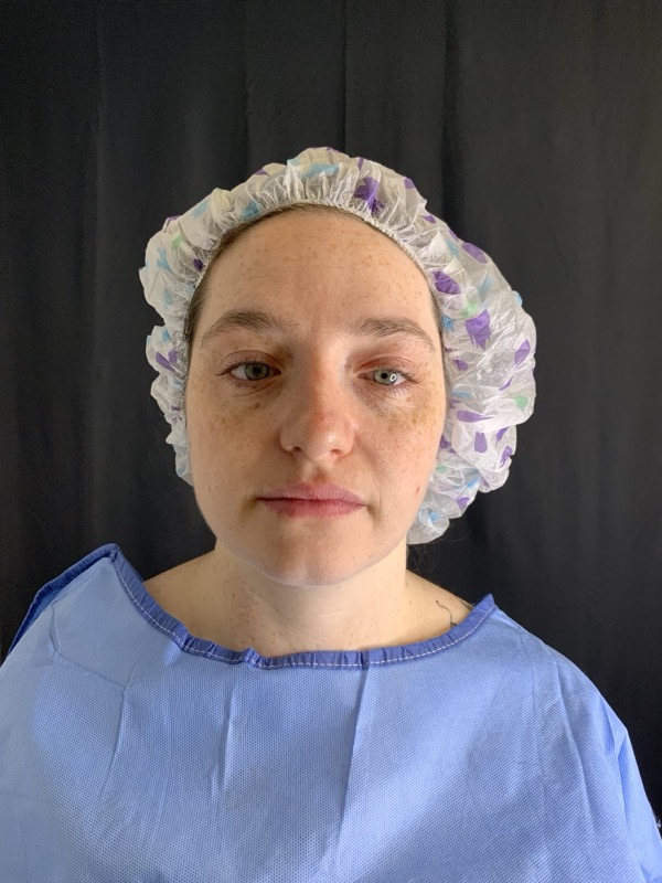 Chin Implant Before & After Image