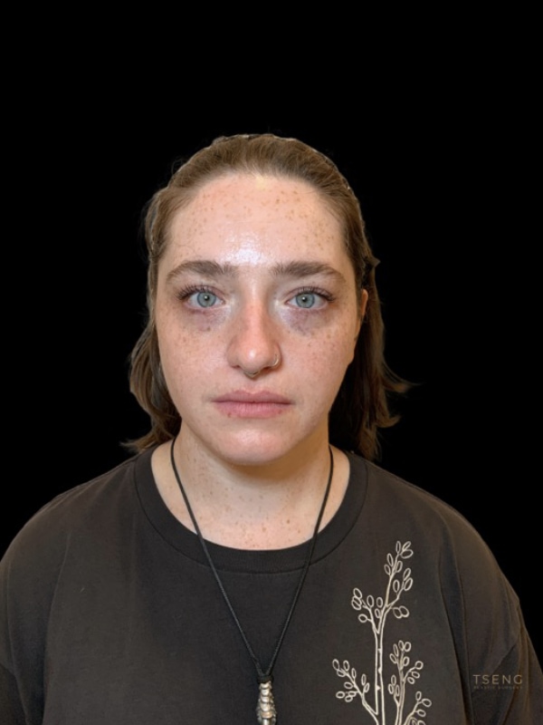 Chin Implant Before & After Image