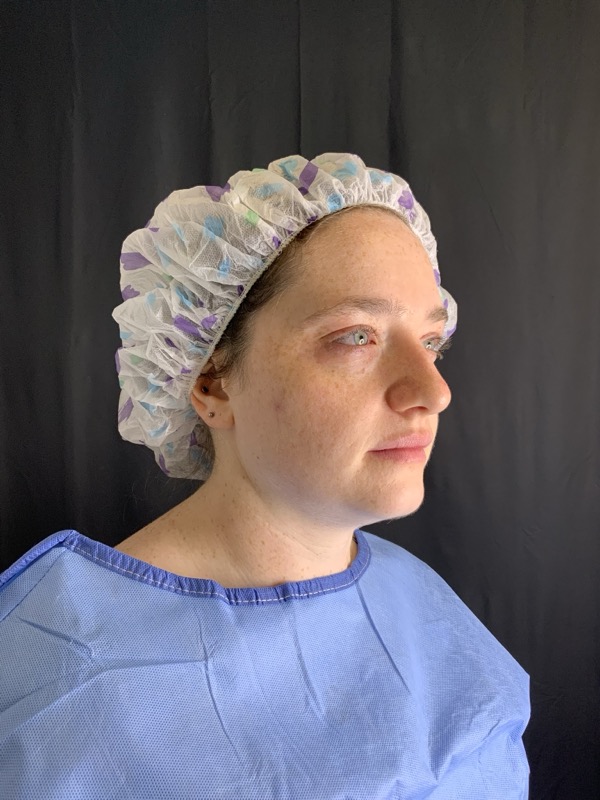 Chin Implant Before & After Image