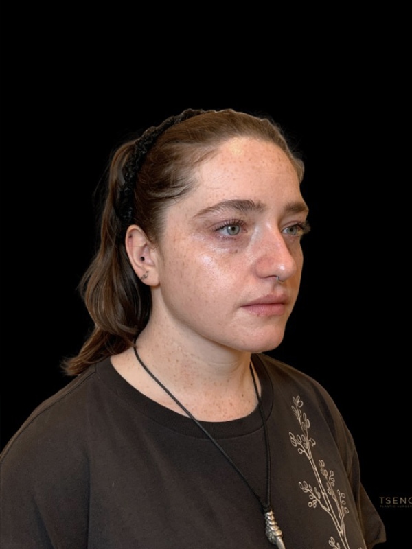 Chin Implant Before & After Image