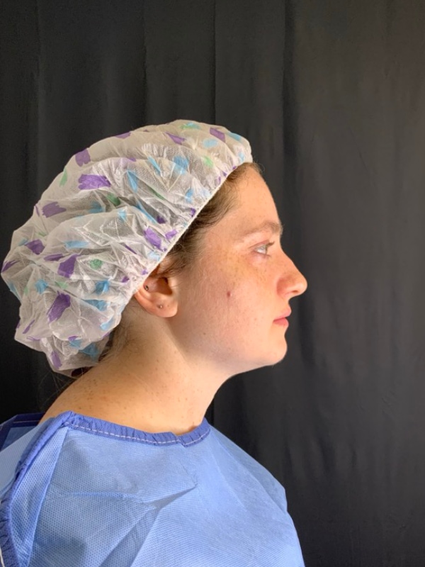 Chin Implant Before & After Image