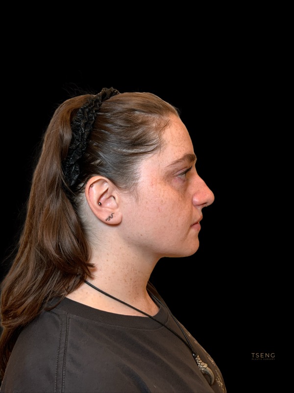 Chin Implant Before & After Image