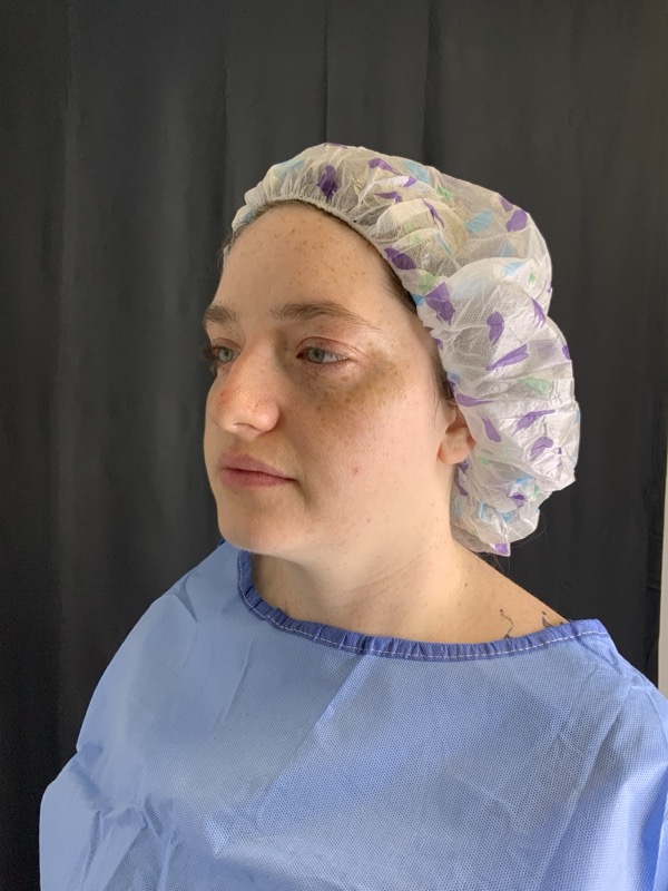 Chin Implant Before & After Image