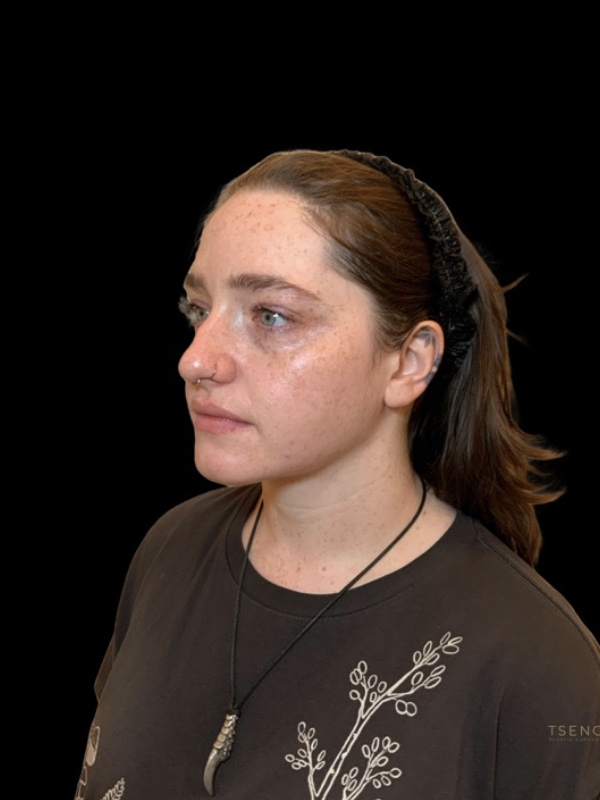 Chin Implant Before & After Image