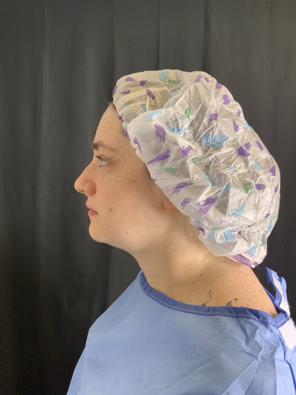 Chin Implant Before & After Image