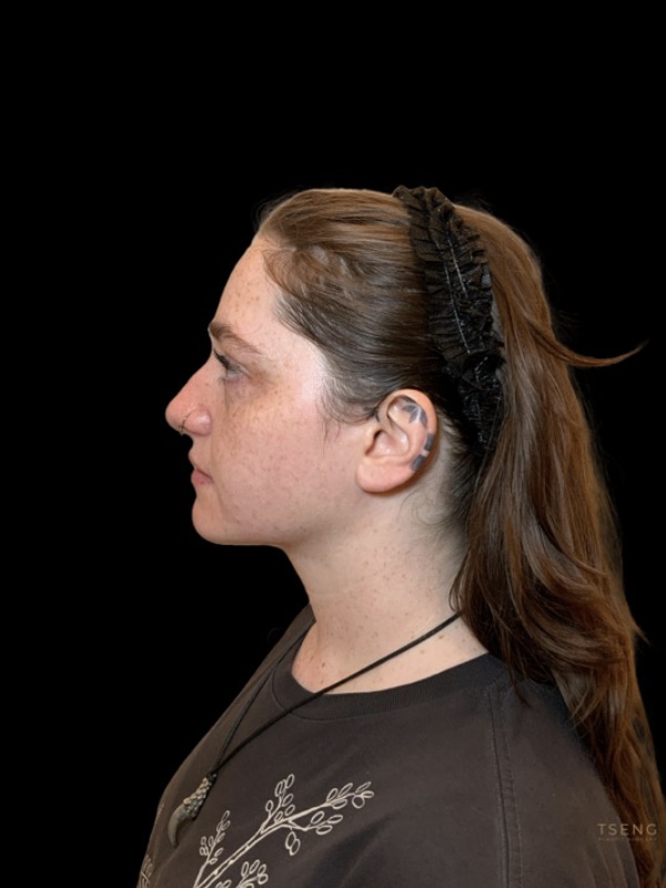 Chin Implant Before & After Image
