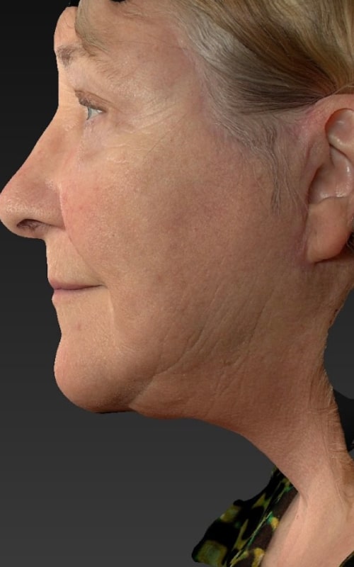 Deep Plane Facelift Before & After Image