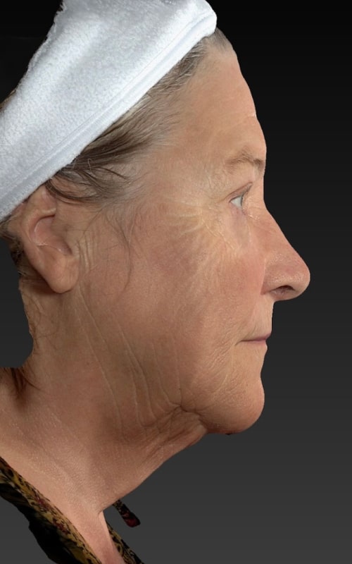 Deep Plane Facelift Before & After Image