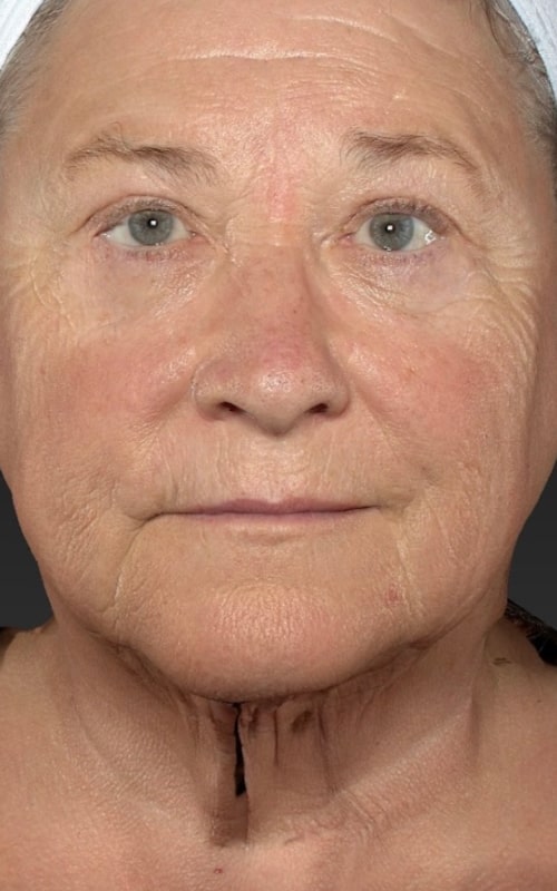 Deep Plane Facelift Before & After Image