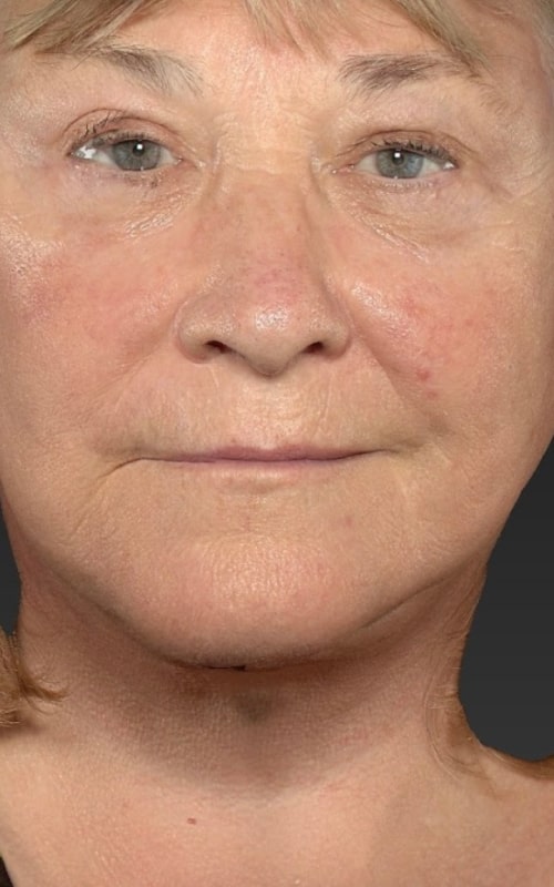 Deep Plane Facelift Before & After Image