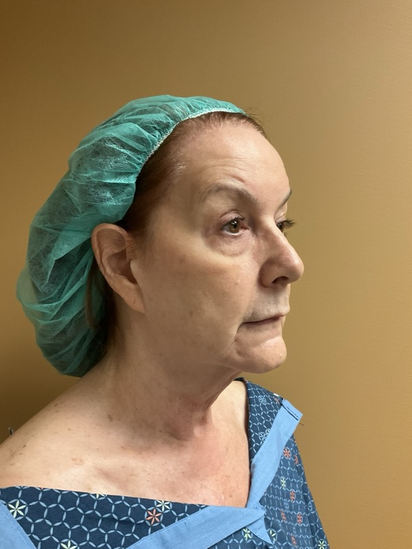 Deep Plane Facelift Before & After Image
