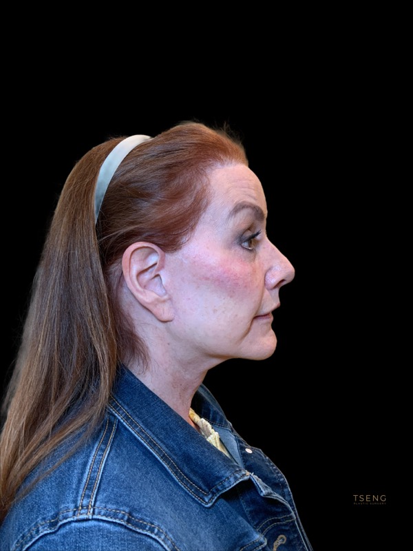 Deep Plane Facelift Before & After Image