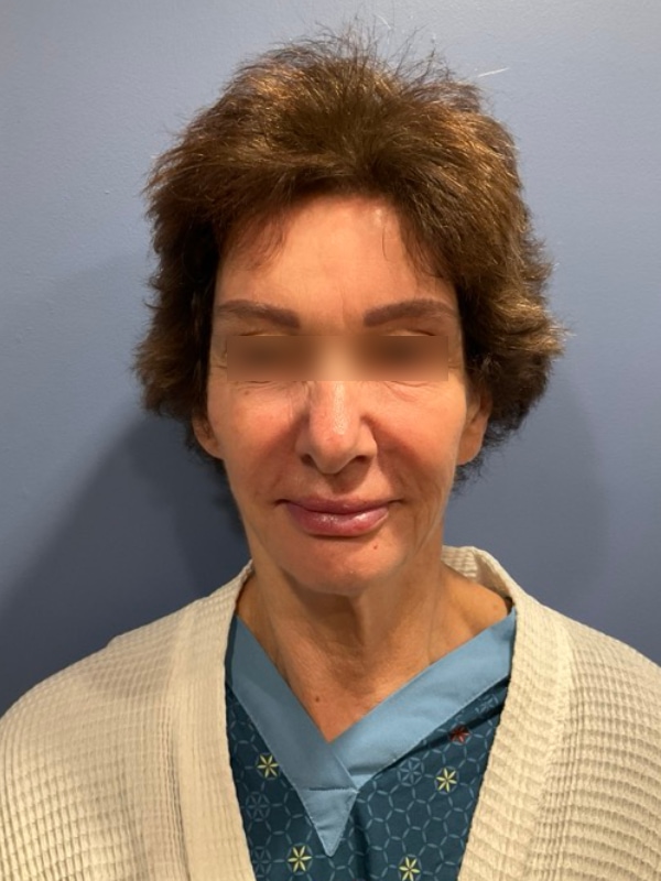 Deep Plane Facelift Before & After Image