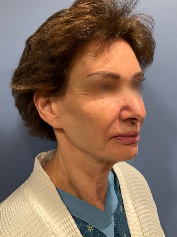 Deep Plane Facelift Before & After Image