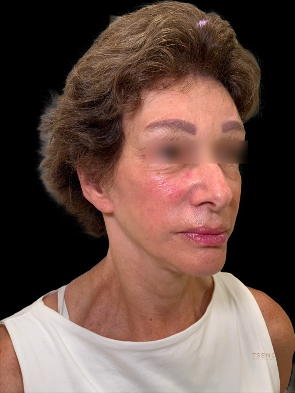 Deep Plane Facelift Before & After Image