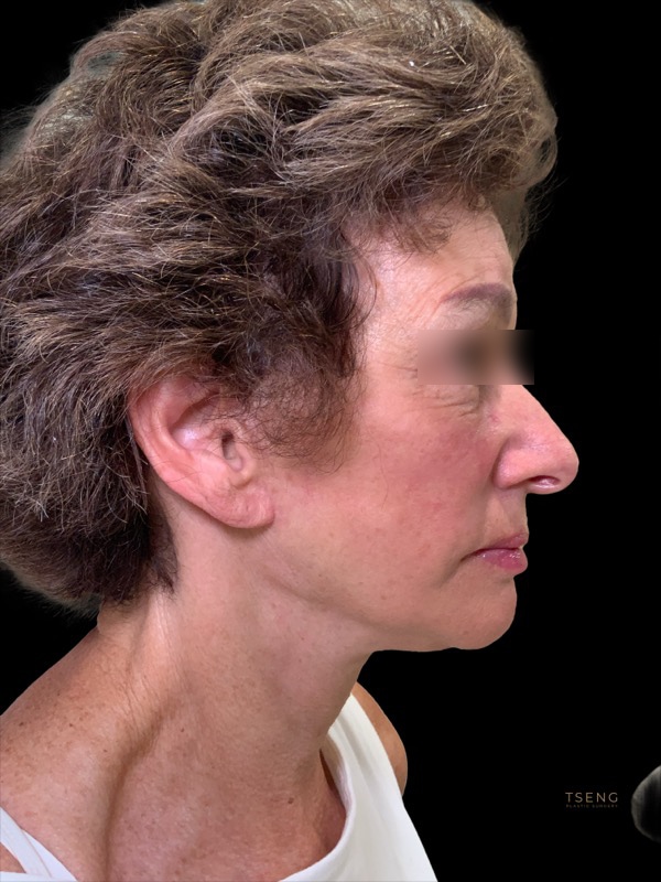 Deep Plane Facelift Before & After Image