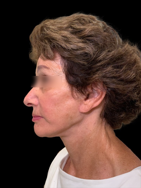 Deep Plane Facelift Before & After Image