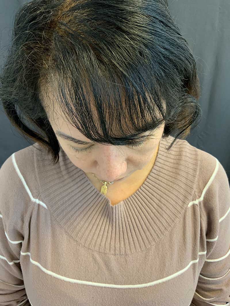 Ethnic Rhinoplasty Before & After Image