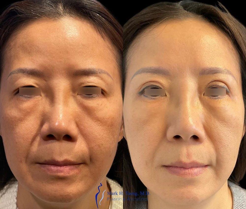 Eyelid Surgery Before & After Image