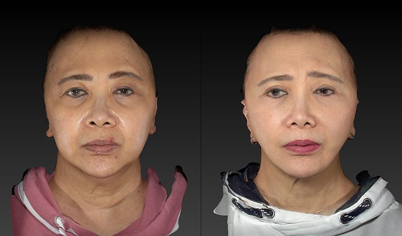 Eyelid Surgery Before & After Image