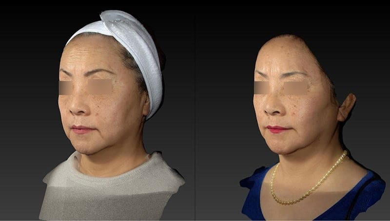 Eyelid Surgery Before & After Image