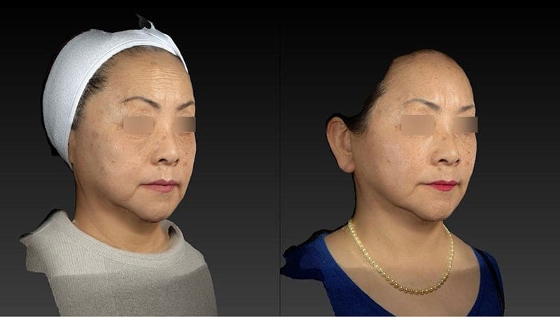 Eyelid Surgery Before & After Image