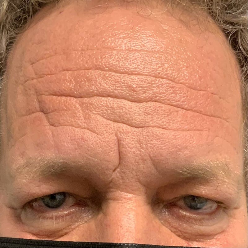 Eyelid Surgery Before & After Image