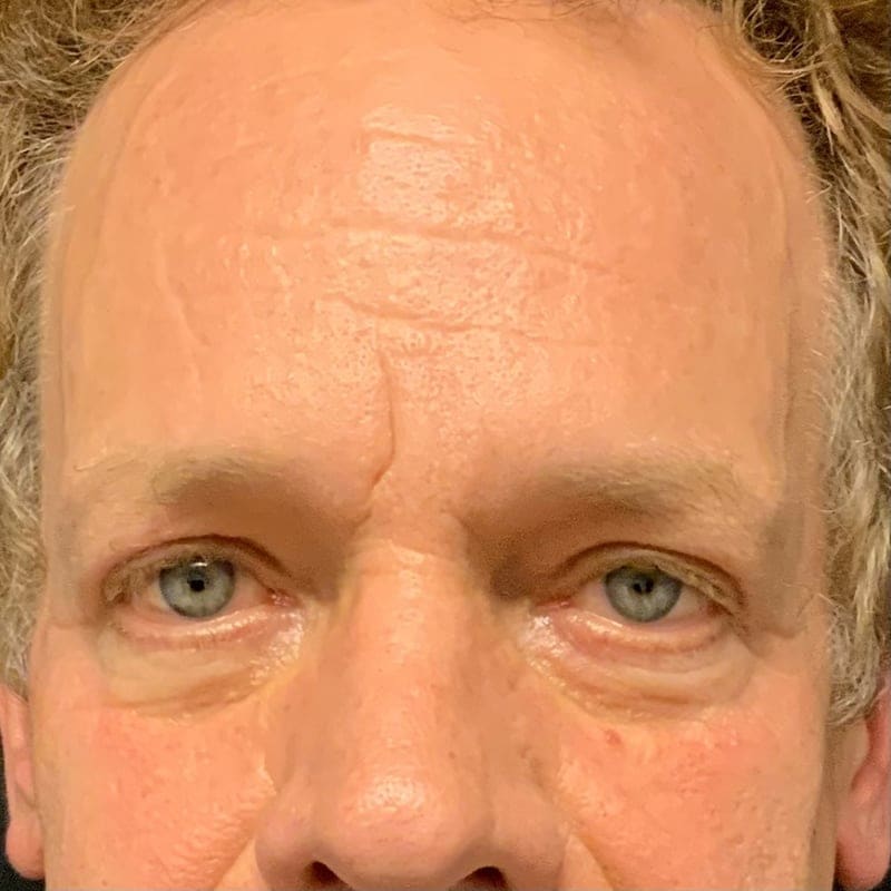 Eyelid Surgery Before & After Image