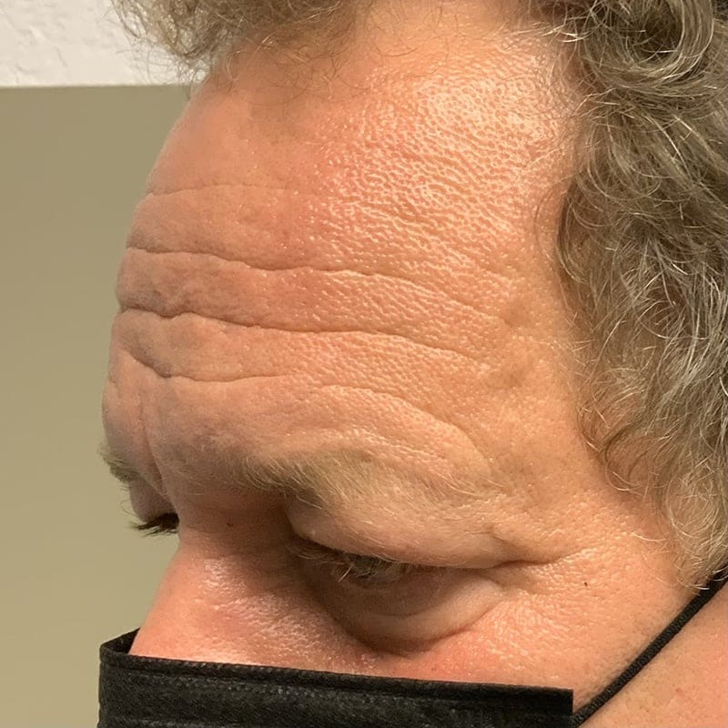 Eyelid Surgery Before & After Image