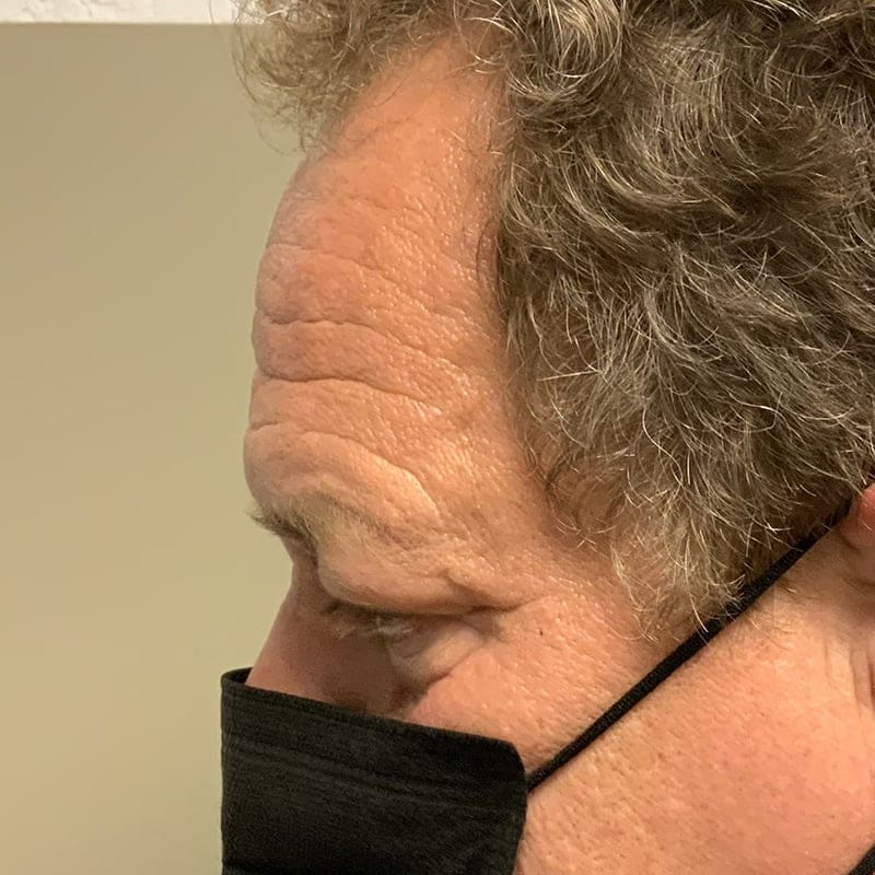 Eyelid Surgery Before & After Image