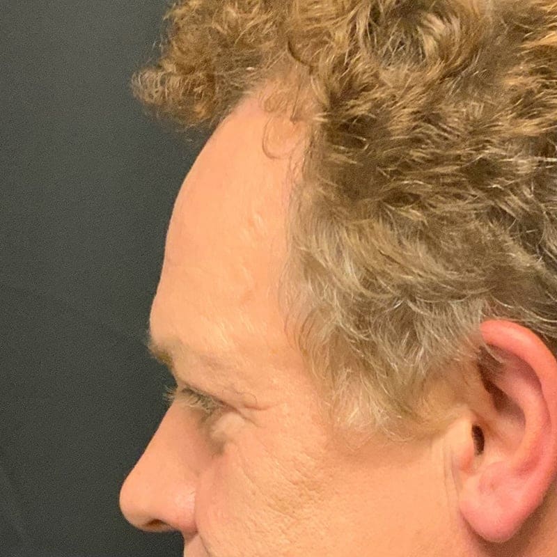 Eyelid Surgery Before & After Image
