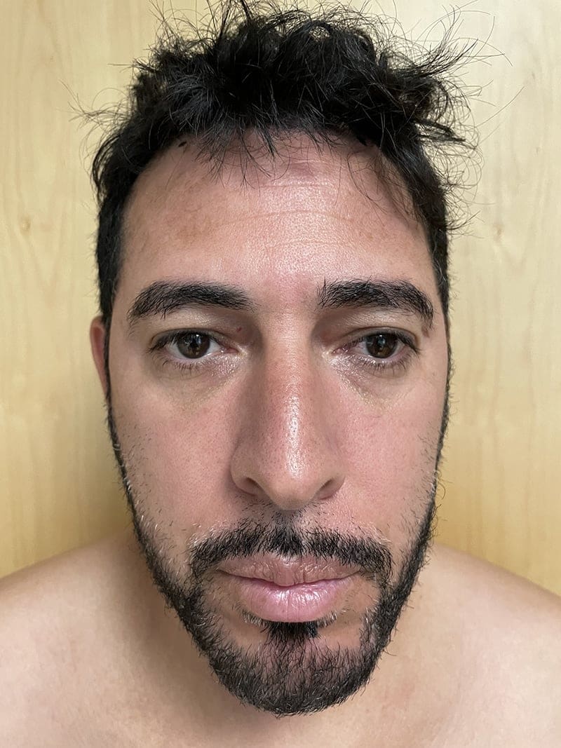 Eyelid Surgery Before & After Image