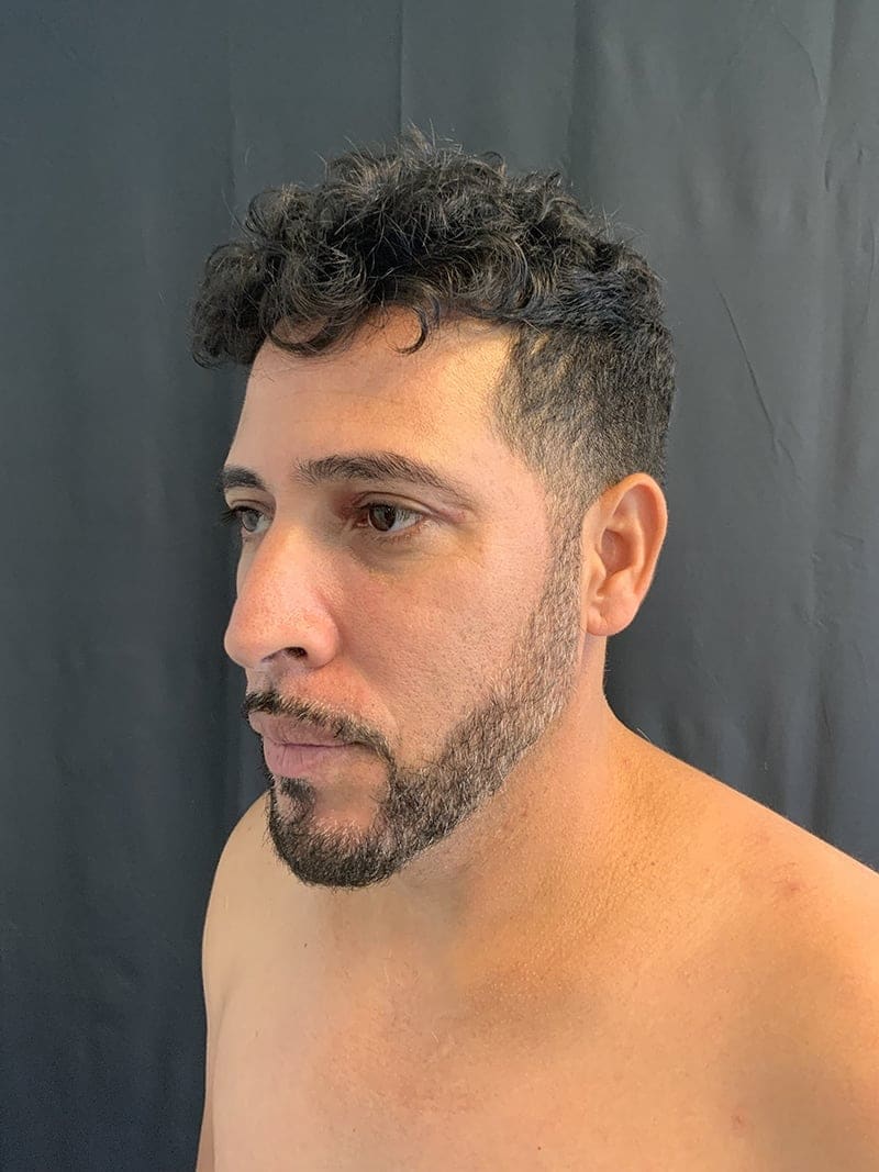 Eyelid Surgery Before & After Image