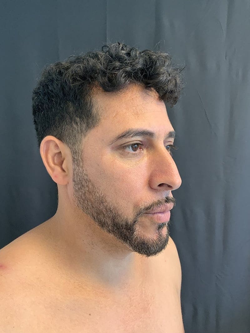 Eyelid Surgery Before & After Image