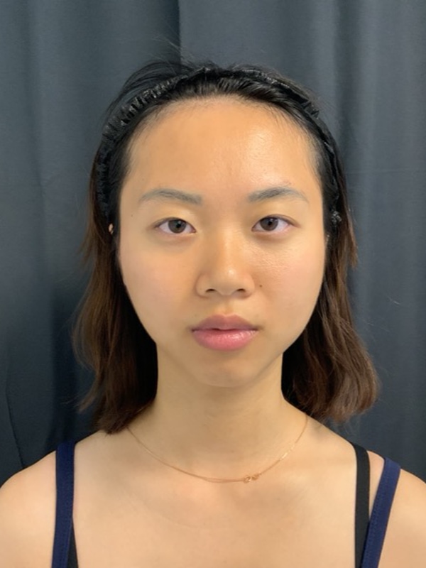 Eyelid Surgery Before & After Image