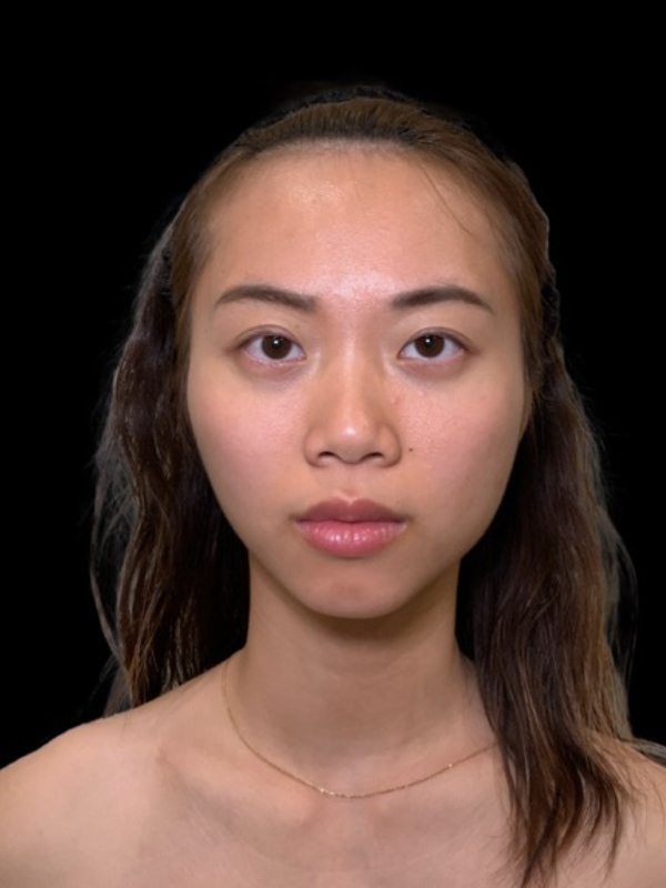 Eyelid Surgery Before & After Image