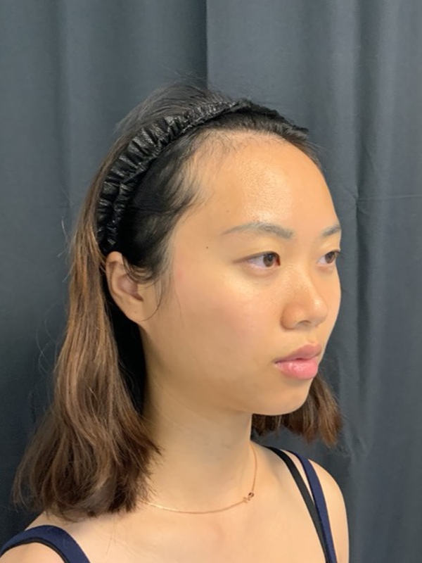 Eyelid Surgery Before & After Image