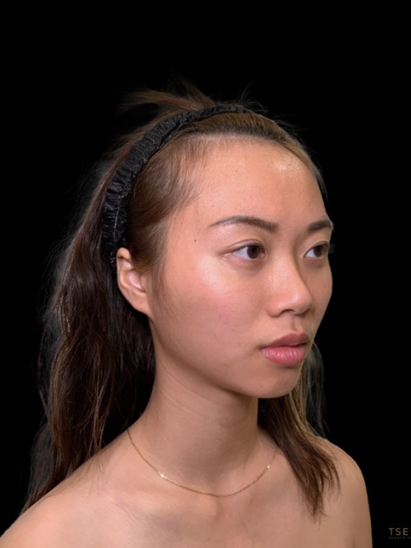 Eyelid Surgery Before & After Image