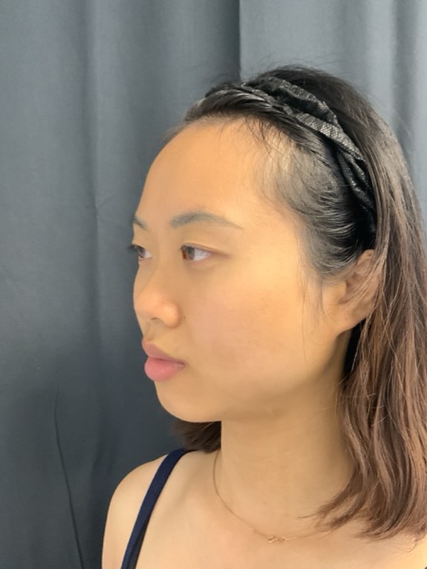 Eyelid Surgery Before & After Image