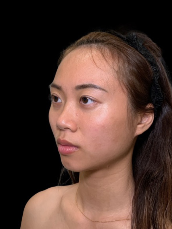 Eyelid Surgery Before & After Image