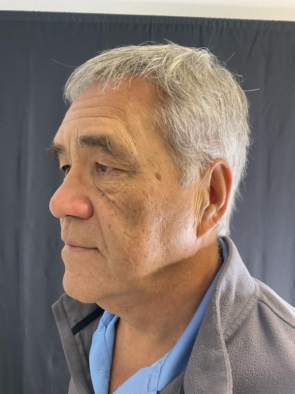 Eyelid Surgery Before & After Image