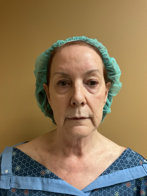Eyelid Surgery Before & After Image