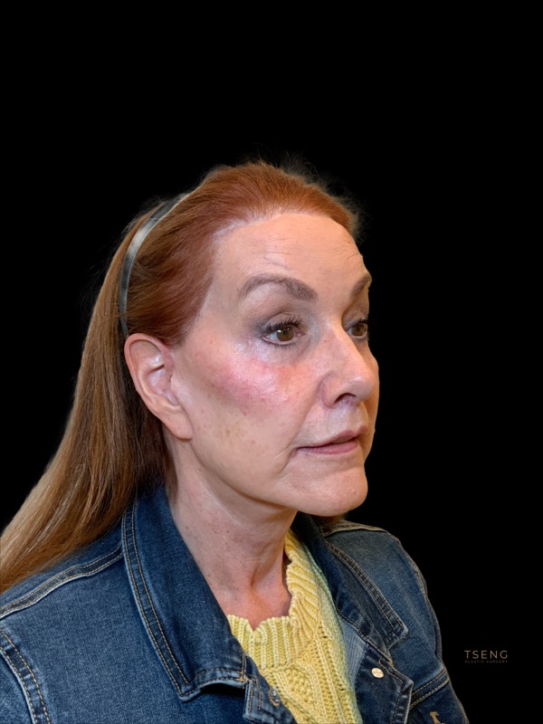 Eyelid Surgery Before & After Image