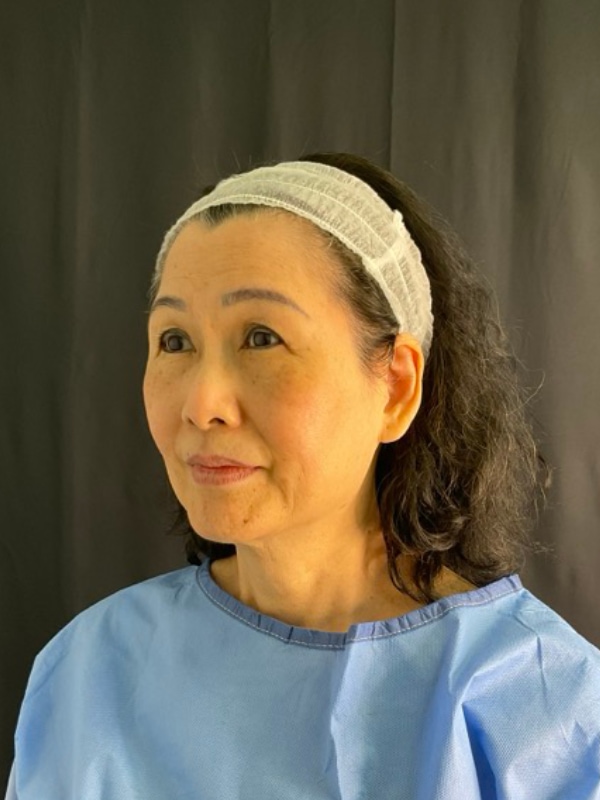 Eyelid Surgery Before & After Image