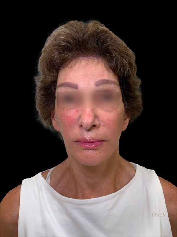 Eyelid Surgery Before & After Image
