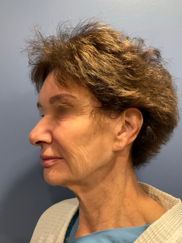 Eyelid Surgery Before & After Image