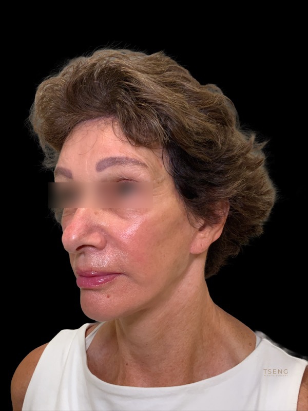 Eyelid Surgery Before & After Image