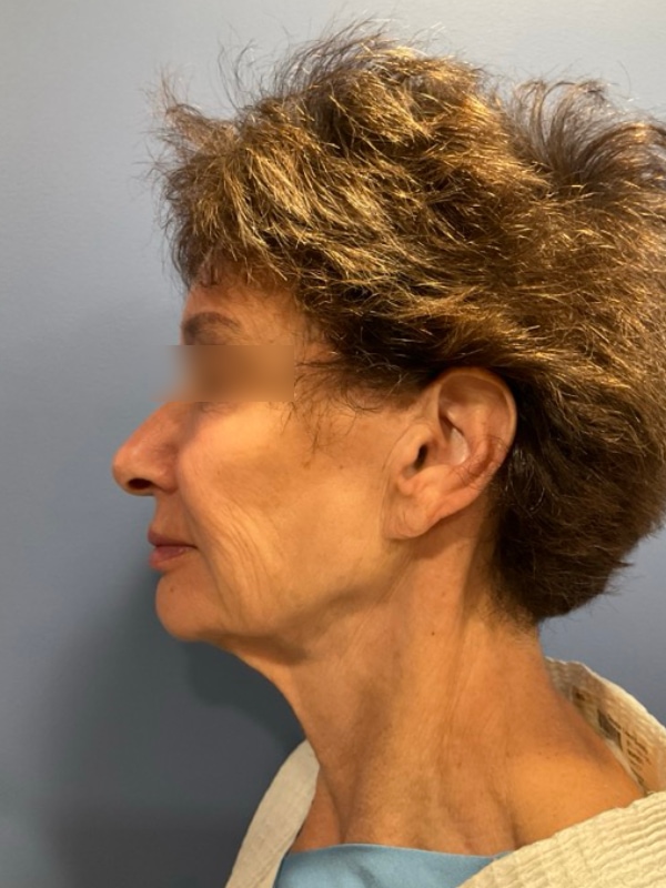 Eyelid Surgery Before & After Image