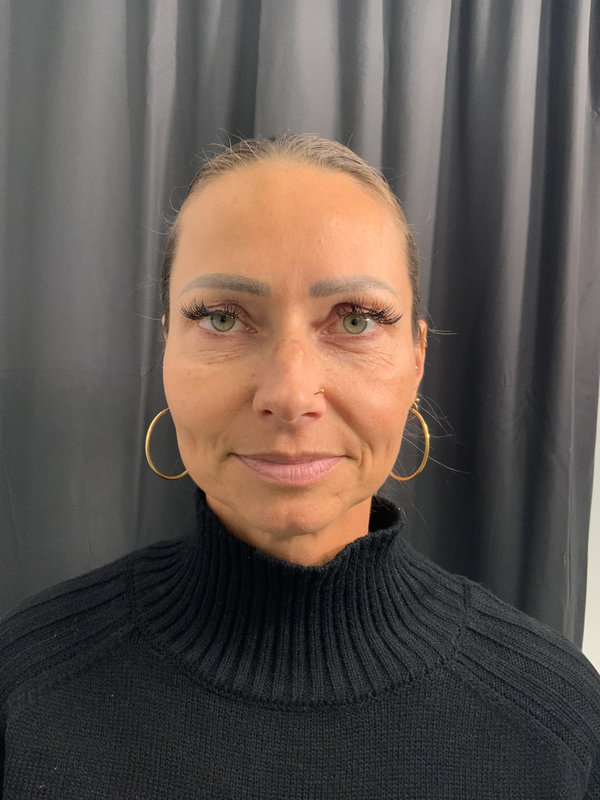 Eyelid Surgery Before & After Image